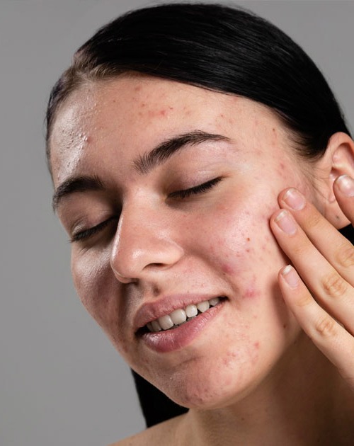 ServiceThumb_ACNE-SCAR