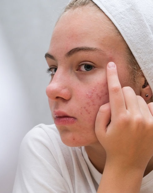 ServiceThumb_ACNE-TREATMENT