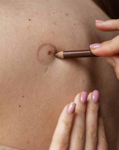 ServiceThumb_MOLE-REMOVAL