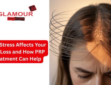 How Stress Affects Your Hair Loss and How PRP Treatment Can Help