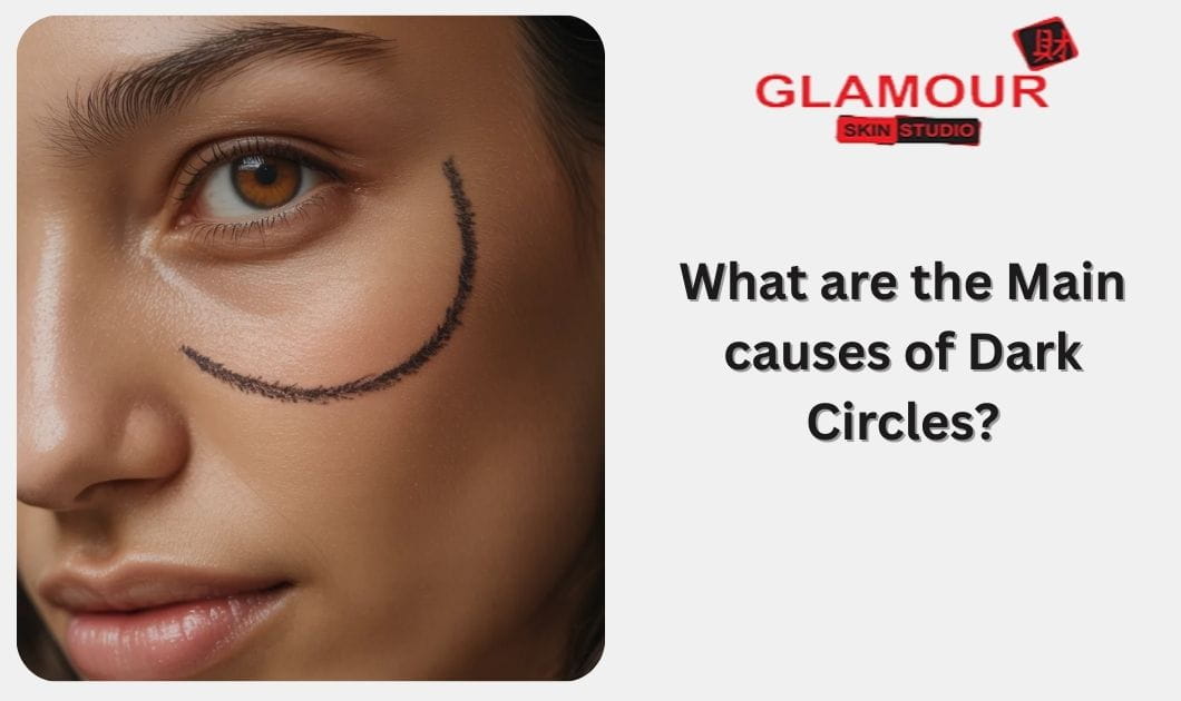 What are the Main causes of Dark Circles