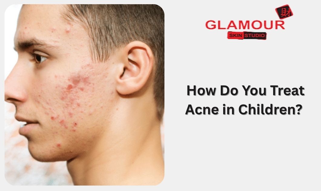 How Do You Treat Acne in Children